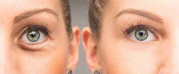 antes e depois do preenchimento das olheoras