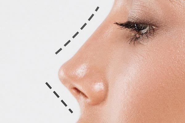 a rinomodelação é um procedimento estético para melhorar a aparência do nariz